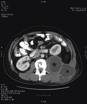 Absceso de psoas y musculatura lumbar izquierda.
