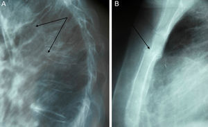 A) Fracturas vertebrales dorsales severas o grado 3 (flechas), en medio fractura moderada o de grado 1-2. B) B Fractura esternal del tercio superior de cuerpo esternal.