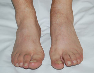 Tumefacción difusa de segundo dedo de pie derecho (dactilitis) y artritis de tobillo izquierdo.