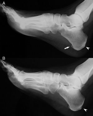 Radiografías de pies que muestra en el derecho (A) un espolón calcáneo (flecha) y entesofitos aquíleos bilaterales (cabezas de flecha).