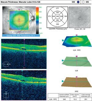Tomografía de coherencia óptica del ojo derecho de la paciente que muestra discreto engrosamiento de la fóvea, con espacio hiporreflectivo en capas externas de la retina (flechas).