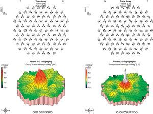 Electrorretinograma multifocal central de la paciente con 100 hexágonos. Se aprecia una disminución moderada de la densidad eléctrica de la región foveolar del ojo derecho (ausencia de blancos).