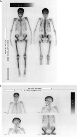 A, B) Centellograma óseo corporal total con 99mTc que muestra hiperfijación a nivel del cráneo, la región maxilofacial, los arcos costales superiores y los huesos largos.