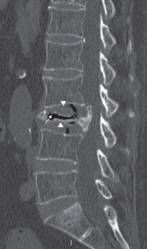 Reconstrucción sagital por TC en la que se aprecia un colapso casi completo del cuerpo vertebral de L3 con desplazamiento del muro posterior condicionando una estenosis del canal medular, e imagen de vacío intravertebral (flecha blanca). También se objetiva signo del vacío discal en L2-L3 y L3-L4 (puntas de flecha).