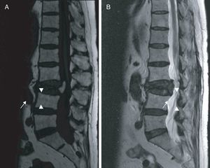 Cortes sagitales en RM en secuencia T1 (A) y T2 (B) mostrando la imagen de vacío de señal en ambas secuencias, secundaria a aire intravertebral. No se objetivan signos de infiltración de la médula ósea ni afectación de partes blandas.