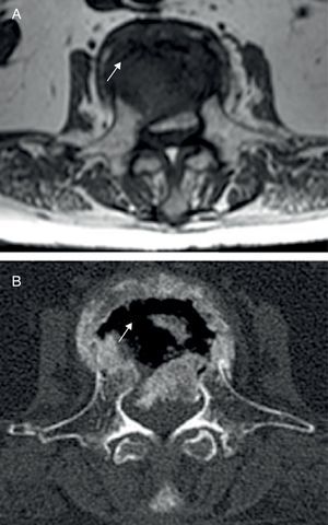 Imágenes axiales en RM (secuencia T1; (A) y TC (B) en las que se demuestra que la imagen de hipointensidad lineal en la RM se corresponde con el aire intravertebral en forma de croissant’ en la TC (flechas blancas).