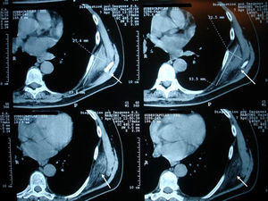 TC sin contraste en la que se observa una masa subescapular izquierda que contacta con los músculos intercostales, de densidad similar al músculo esquelético, con áreas de atenuación similar a la grasa subcutánea (flechas).