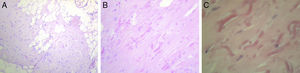 A) Proliferación de tejido colágeno denso y adiposo, paucicelular (HE, 100×). B) Escasas células de núcleos pequeños, elongados y fibras elásticas fragmentadas, de contornos redondeados (HE, 250×). C) Detalle de las alteraciones de las fibras elásticas (HE, 400×).