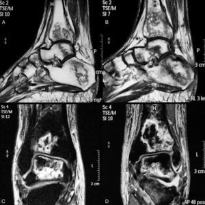 RM tobillos y tarsos. En los cortes longitudinales de la secuencia en T1 se observan extensos infartos óseos afectando la extremidad distal de tibia, calcáneo, astrágalo y elementos del medio pie, tanto en el lado derecho (A) como en el izquierdo (B). En los cortes coronales en la secuencia STIR se observan igualmente extensos infartos en región distal de tibias y astrágalo, mayores en el lado izquierdo que en el derecho (D y C, respectivamente), así como derrame en las interlíneas articulares.