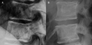 Amplificación de los cuerpos vertebrales D11-D10 (A) y L3-L4 (B) mostrando en detalle las líneas paralelas a la cortical que dan el aspecto de una copia pequeña del cuerpo vertebral en su interior (signo del «hueso dentro de hueso»).