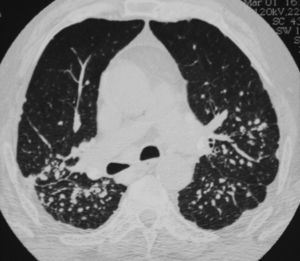 Neumoconiosis y nódulos reumatoides pulmonares.