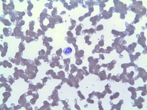 Linfocitosis por LGG.
