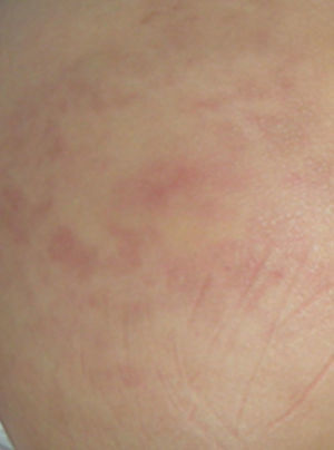Lesiones eritematosas, sobreelevadas, en nalgas (paniculitis facticia).