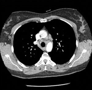 TC torácica. Adenopatías hiliares y mediastínicas (sarcoidosis grado 1).