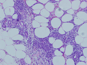 Paniculitis facticia: histiocitos con vacuolas lipídicas intracitoplasmáticas.