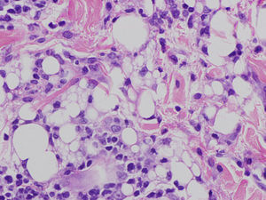 Eritema nodoso: granulomas en panículo adiposo sin necrosis.