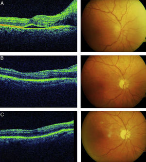 Tomografías de coherencia óptica (izquierda) y retinografías (derecha) del ojo derecho del paciente a los 7 meses tras el tratamiento con infliximab (A) y a los 2 (B) y 4 (C) meses tras cambiar el tratamiento anti-TNF-α a adalimumab.