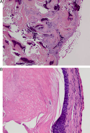 A) Tumoración de la matriz pilosa bien delimitada, no encapsulada. Proliferación celular en la que se distinguen lóbulos formados por células de aspecto basaloide, queratinización y calcificaciones distróficas (hematoxilina-eosina). B) A mayor detalle, proliferación de células epitelioides basófilas que sufren una queratinización abrupta y presencia de células eosinófilas llamadas células fantasma (hematoxilina-eosina).