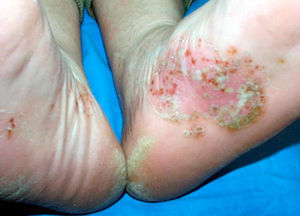 Queratodermia blenorrágica.