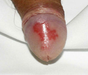 Balanitis circinada.
