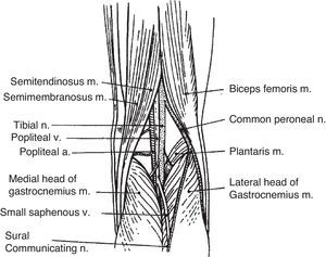 A simple drawing of the popliteal fossa. Baker cysts occur by distention of a communicating gastrocnemius–semimembranosus bursa. This bursa is placed in the junction of the middle third and the lateral 2/3 of the popliteal fossa.