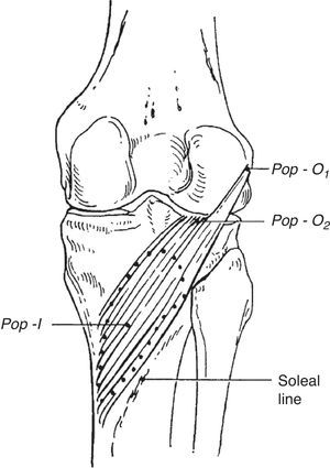 Popliteus muscle. Two insertions are shown, in the lateral femoral condyle below the epicondyle and in the back of the lateral meniscus. Its insertion is in the posterior surface of tibia above soleal line.