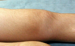 Swelling of the deep infrapatellar bursa. The patient