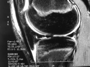 The distended infrapatellar bursa is seen between the upper tibia and the patellar tendon that appears black. The bursal fluid is intense white. A hanging portion of the fat pad is seen in black on the top.