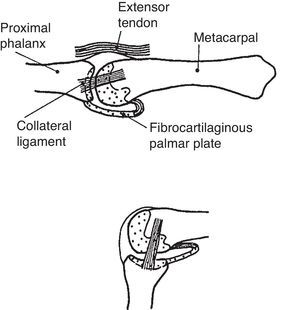 Upper panel. MCP joint showing the metacarpophalangeal joint (MCP) in neutral. The collateral ligament is relaxed. Note tibrocartilaginous palmar plate in the palmar aspect of the joint. Lower panel. The lateral collateral ligament becomes taut in flexion. From A Companion to Medical Studies, Volume 1, Ed. by Passmore R and Robson JS, 2nd Edition, Oxford, Wiley/Blackwell 1976, p. 23.16, with permission.