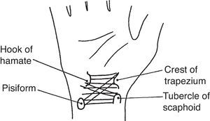 This sketch depicts the four main osseous insertions of the transverse carpal ligament. This ligament binds anteriorly the carpal tunnel. From A Companion to Medical Studies, Volume 1, Ed. by Passmore R and Robson JS, 2nd Edition, Oxford, Wiley/Blackwell 1976, p. 23.22, with permission.