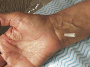 One of the techniques of infiltration in carpal tunnel syndrome is shown. The needle is inserted ulnar to the palmaris longus tendon 1.5–2cm proximal to the distal flexor crease of the wrist.