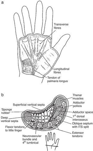 (a) The palmar fascia. The longitudinal fibers derive from palmaris longus tendon. Note the transverse fibers of palmaris brevis, a subcutaneous musle at the hypothenar eminence. From A Companion to Medical Studies, Volume 1, Ed. by Passmore R and Robson JS, 2nd Edition, Oxford, Wiley/Blackwell 1976, p. 23.16, with permission. (b) A transverse section of the hand. The palmar fascia is located near the palmar surface. It is connected to the dermis by fibrous strands that loculate tiny fat lobules. Septae connect the deep aspect of the palmar fascia to the deep fascia that overlies the metacarpals and the interosseous muscles (the insert shows the site of the section). From A Companion to Medical Studies, Volume 1, Ed. by Passmore R and Robson JS, 2nd Edition, Oxford, Wiley/Blackwell 1976, p. 23.16, with permission.
