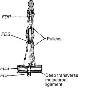 This is a simplified rendition of the fibrous digital pulleys. The proximal pulley, A1, inserts in the palmar plate and in the transverse metacarpal ligament that binds neighboring palmar plates. From A Companion to Medical Studies, Volume 1, Ed. by Passmore R and Robson JS, 2nd Edition, Oxford, Wiley/Blackwell 1976, p. 23.22, with permission.