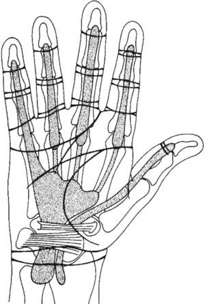 This figure shows the relationship between the transverse palmar creases and the flexor synovial sheaths. Note that for the digits 2,3,4 the synovial sheaths end near the transverse creases. For the thumb and the small finger the sheaths extend to the distal forearm. The expansion of the latter in the mid palm is the ulnar bursa, a synovial structure extends to the carpal tunnel and the distal forearm. From A Companion to Medical Studies, Volume 1, Ed. by Passmore R and Robson JS, 2nd Edition, Oxford, Wiley/Blackwell 1976, p. 23.24, with permission.