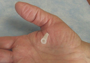 In the trigger thumb the needle is inserted toward the sesamoid bones, which coincide with the proximal anular pulley of the thumb.