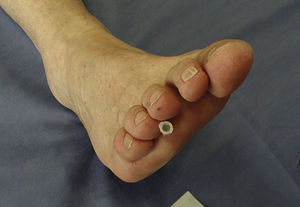 Needle insertion for steroid injection in Morton's neuroma. Technique learned from Dr. Lilia Andrade Ortega, Mexico City.