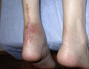 Patient 1. Disfiguring scar after surgical repair of a fluoroquinolone/corticosteroid-related non-insertional Achilles tendinopaty leading to rupture.