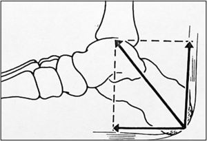 The Achilles-calcaneal-plantar system. Traction is exerted on the calcaneal tuberosity by the Achilles tendon and the plantar fascia. The resulting force vector is shown.