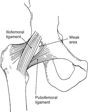The iliofemoral and pubofemoral ligaments. The weak area is the capsular area where in adults a connection is often created spontaneously between the hip joint and the iliopsoas bursa. This acquired connection allows joint fluid enter and disted the bursa as an iliopsoas cyst.