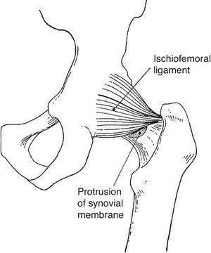 The hip joint as seen from the back. The ischiofemoral ligament is prominently seen in this view.