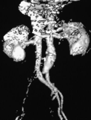 In this patient (Patient 5) the angio-TAC showed complete occlusion of the right iliac artery.