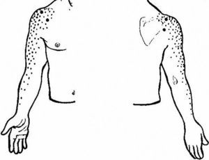 This sketch shows with dots pain radiation from the glenohumeral joint and the rotator cuff (C5 and C6-derived structures). The left half of the picture shows the front side and the right side of the picture the back side.