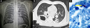 A) Radiografía de tórax con múltiples cavidades, una gigante en el lóbulo inferior derecho. B) Tomografía de tórax que muestra cavidad con pared gruesa. C) Material histopatológico en biopsia pulmonar con bacilos ácido-alcohol resistentes (flecha) (tinción de Ziehl-Neelsen).
