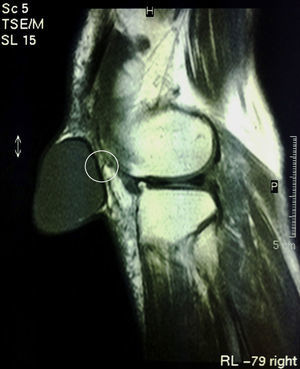 Resonancia magnética de la rodilla. Dentro del círculo se identifica el pliegue de la pared posterior del quiste.