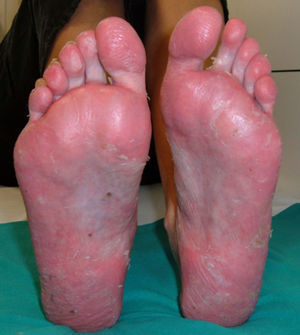 Pustulosis plantar con afección ungueal en paciente con enfermedad de Crohn fistulizante tras inicio de tratamiento con adalimumab.