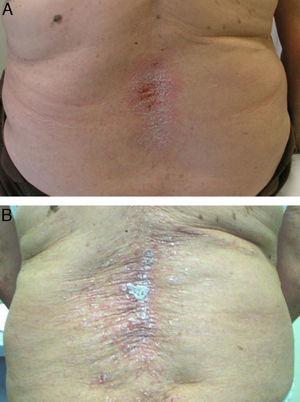 Paciente con artritis psoriásica que presentó exacerbación de lesiones psoriásicas a los 11 meses de etanercept. A) Mejoría de las lesiones a las 6 semanas tras discontinuar etanercept. B) Recurrencia de las lesiones a las 6 semanas tras el reinicio de etanercept.