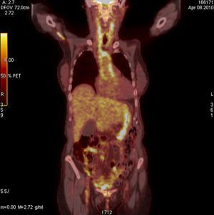 Arteritis de células gigantes. Se observan lesiones hipermetabólicas en la pared vascular de la aorta, tronco braquiocefálico, carótidas y subclavias.