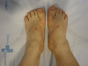 Pies. Engrosamiento difuso de partes blandas.