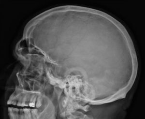 Radiografía simple de cráneo. Aumento de tamaño de la silla turca. Engrosamiento de la bóveda craneal. Tamaño aumentado de los senos paranasales.