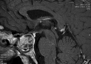 Resonancia cerebral. Adenoma hipofisario.